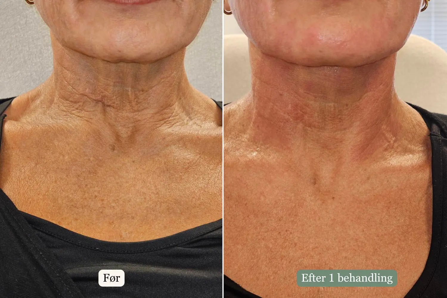 Før og efter HIFU-behandling — Hals