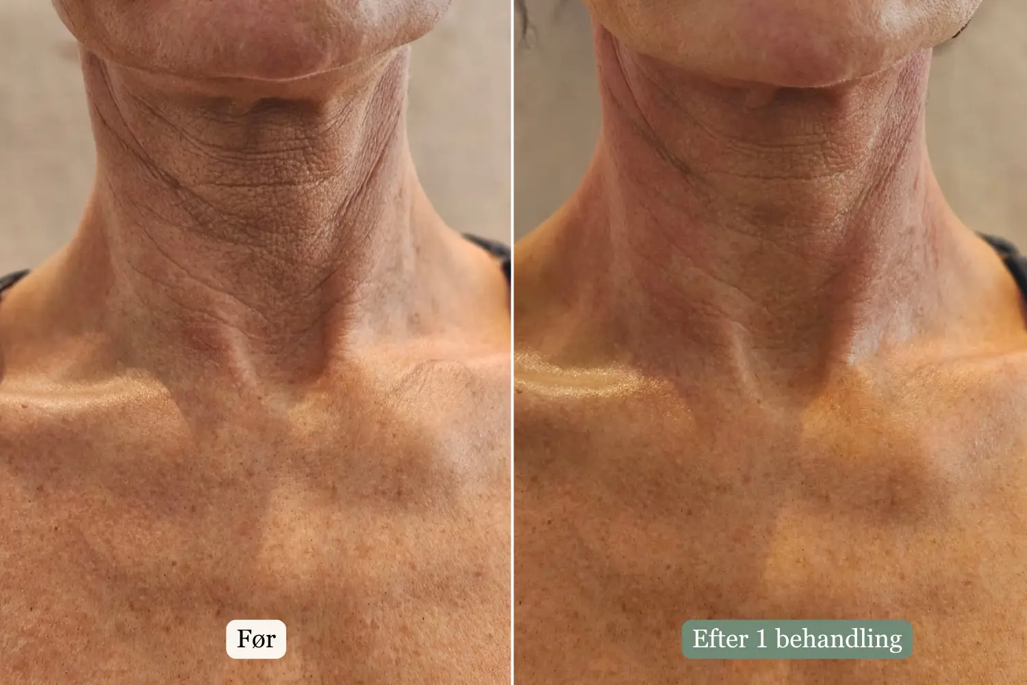 Før og efter HIFU-behandling — Hals & dekolleté