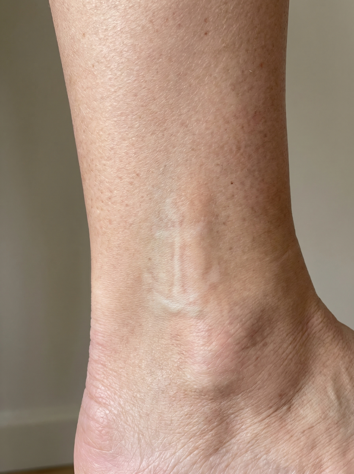 Næsten usynlig tatovering på ankel efter laserbehandling