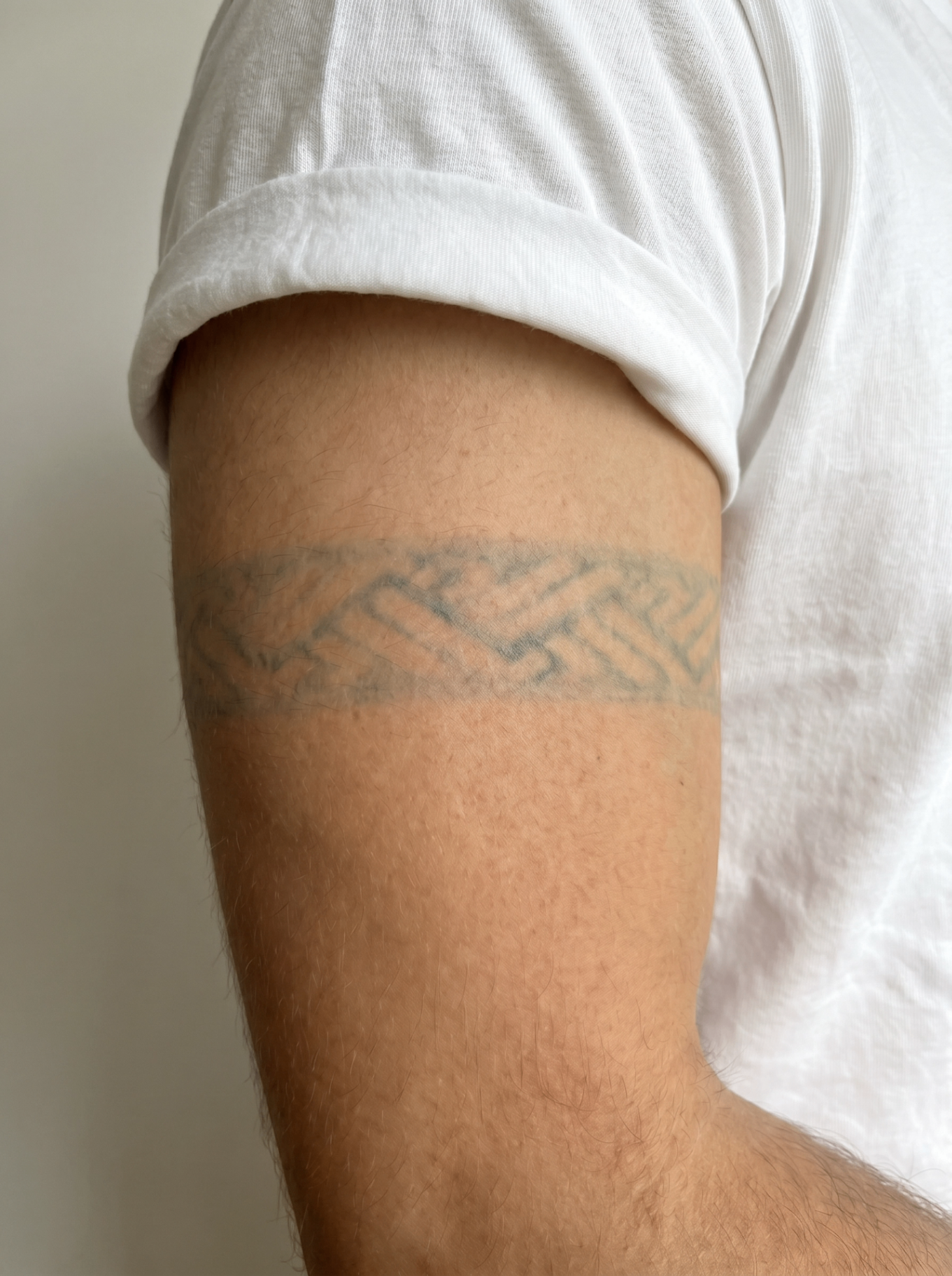 Tatovering på overarm før laserfjernelse