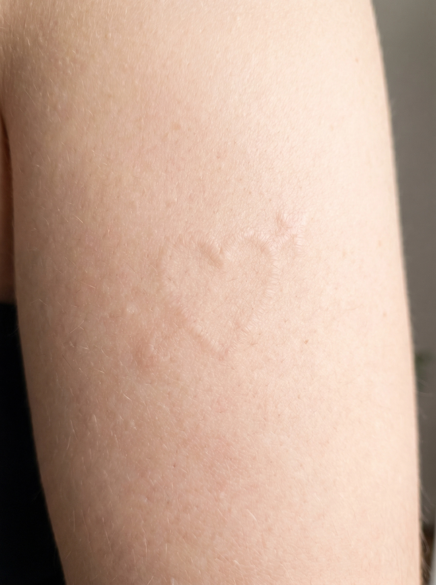 Hud efter fjernelse af tatovering på triceps