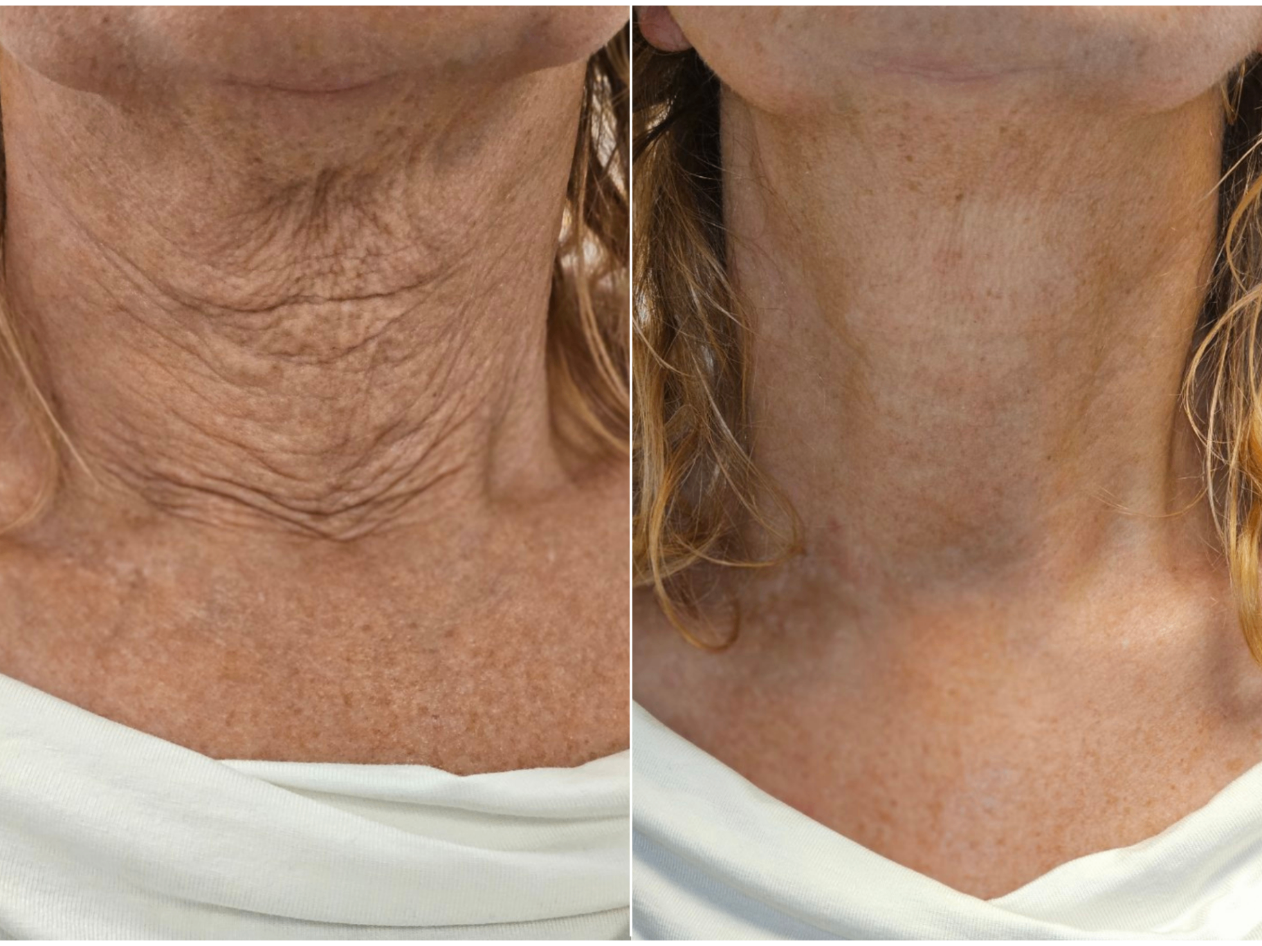 Ansigtsløft & halsløft